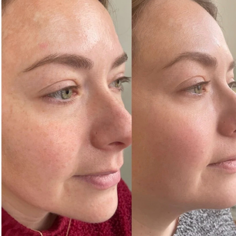 Lazer Peel at Kori Williams-Skinologist in Pasco, WA