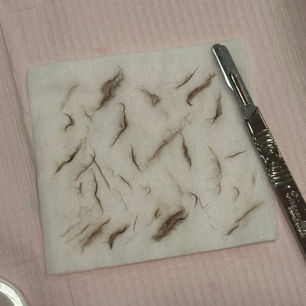 Dermaplane at Ava's Aesthetics in Marshall, IL