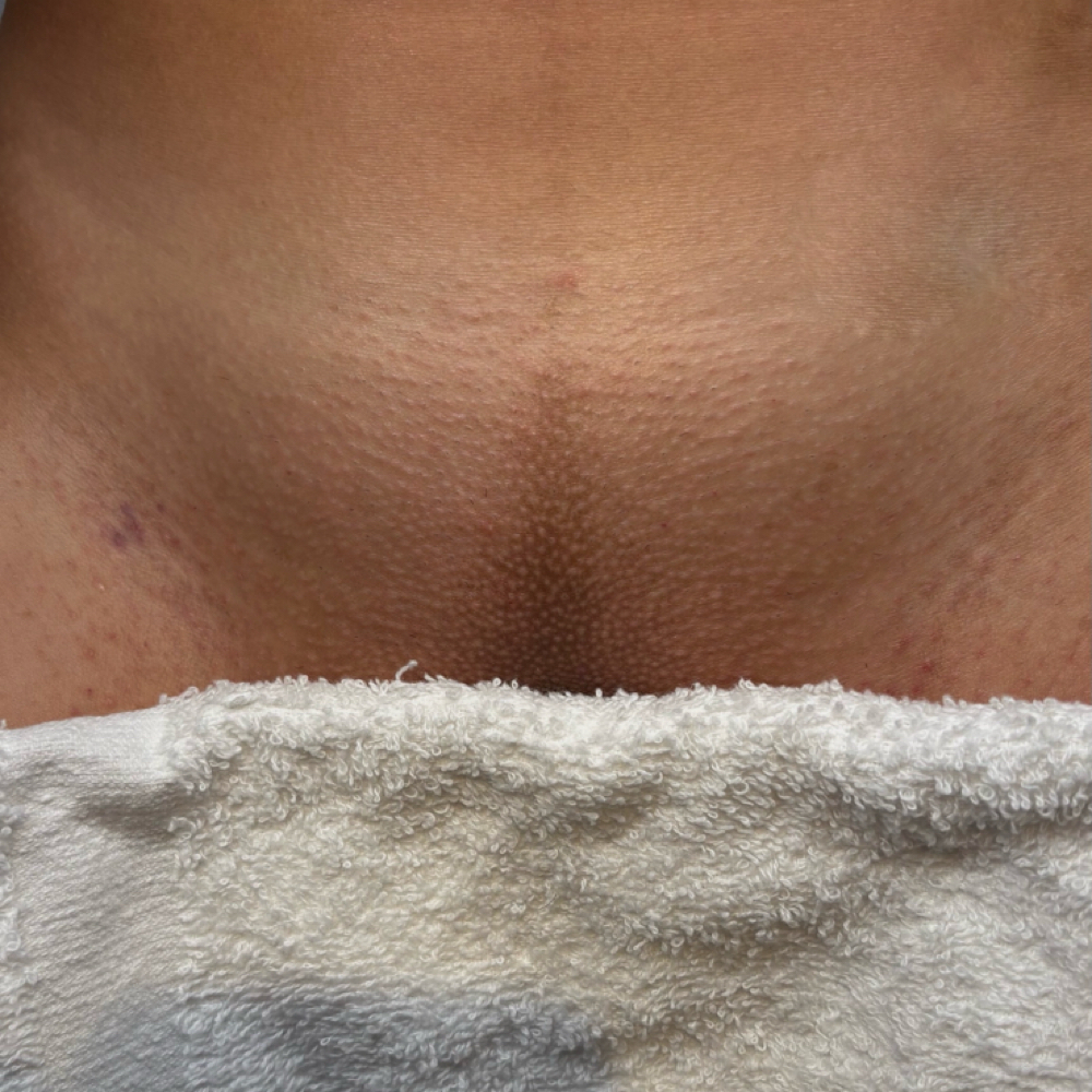 Brazilian Wax at Aura Esthetics & Lashes in Quaker Hill, CT