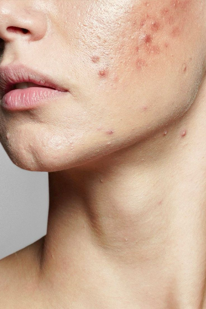 Clear Complexion Facial