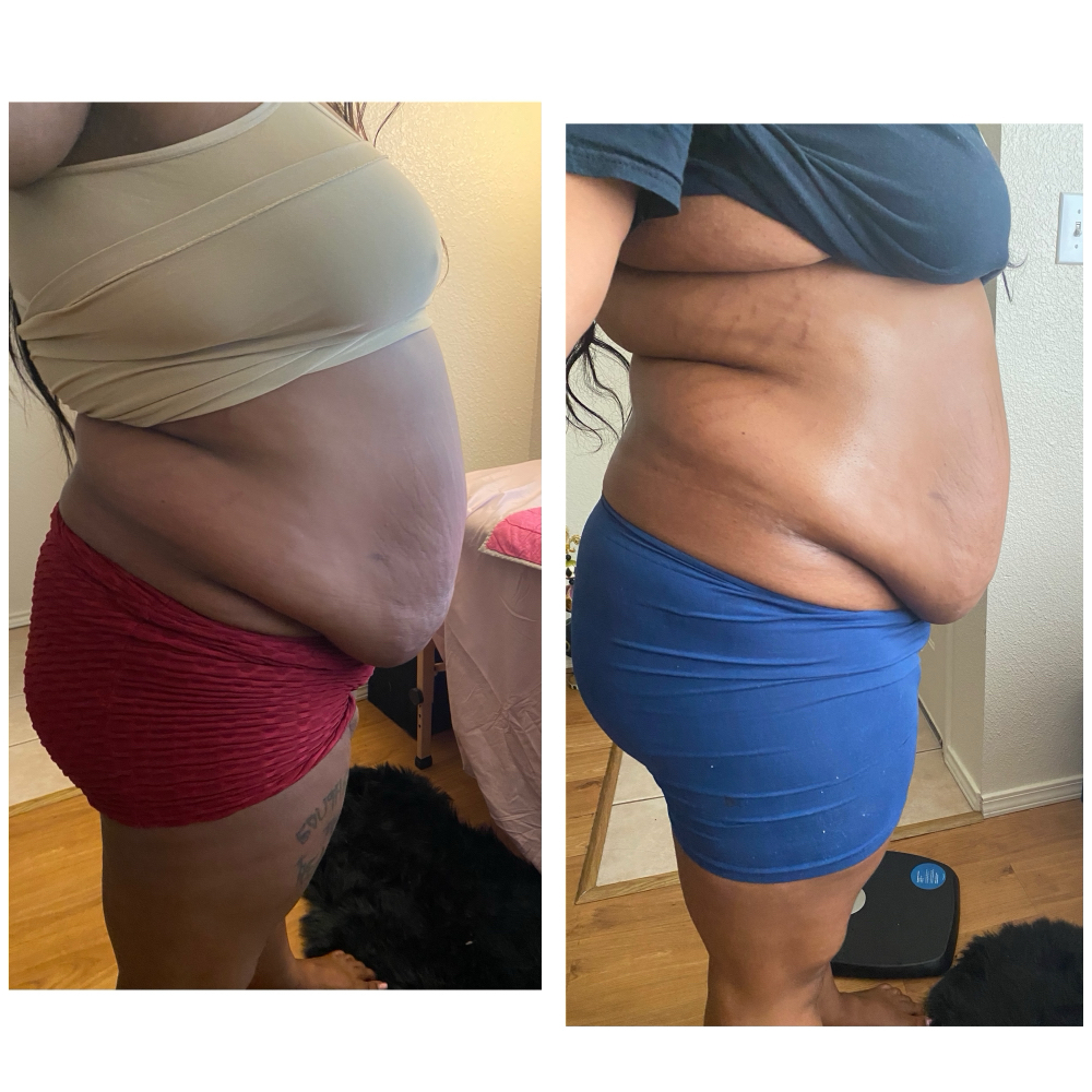 Laser Lipo - 6 Sessions (Belly) at 210 The Body Bar | San Antonio Lux Spray Tans & Body Sculpting in San Antonio, TX