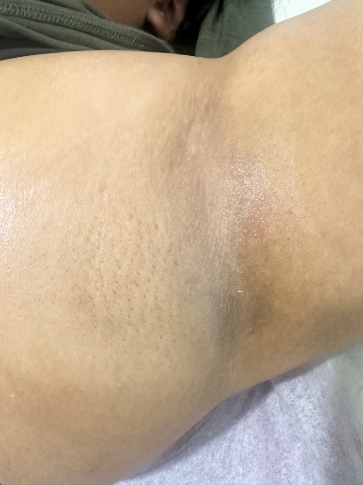Underarms