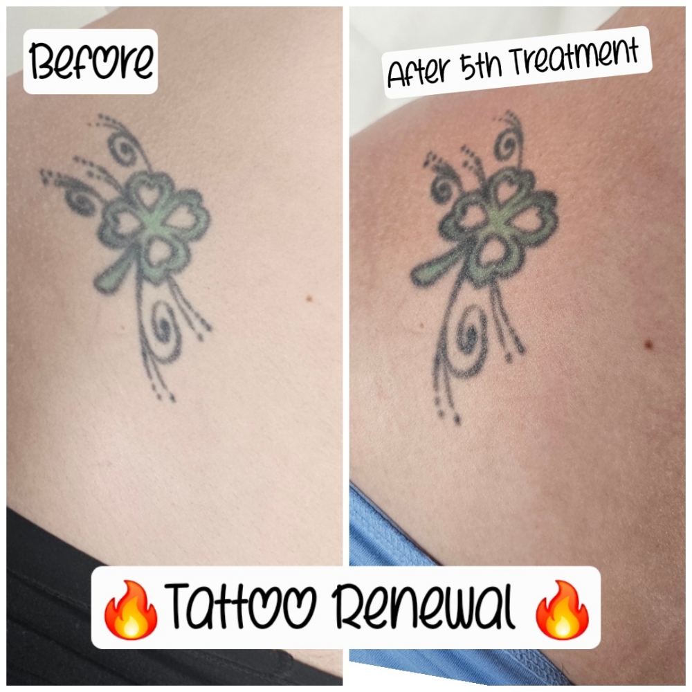 Tattoo Renewal Cryotherapy