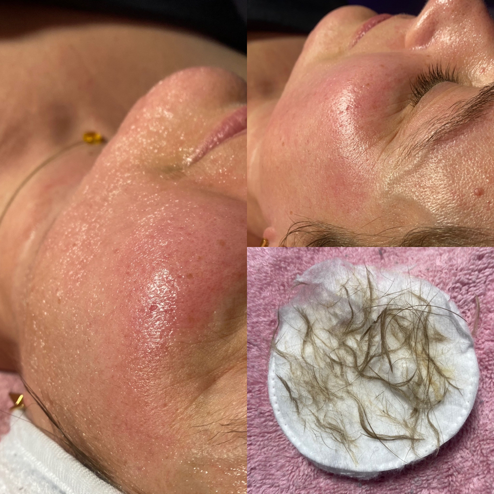 Dermaplane Facial