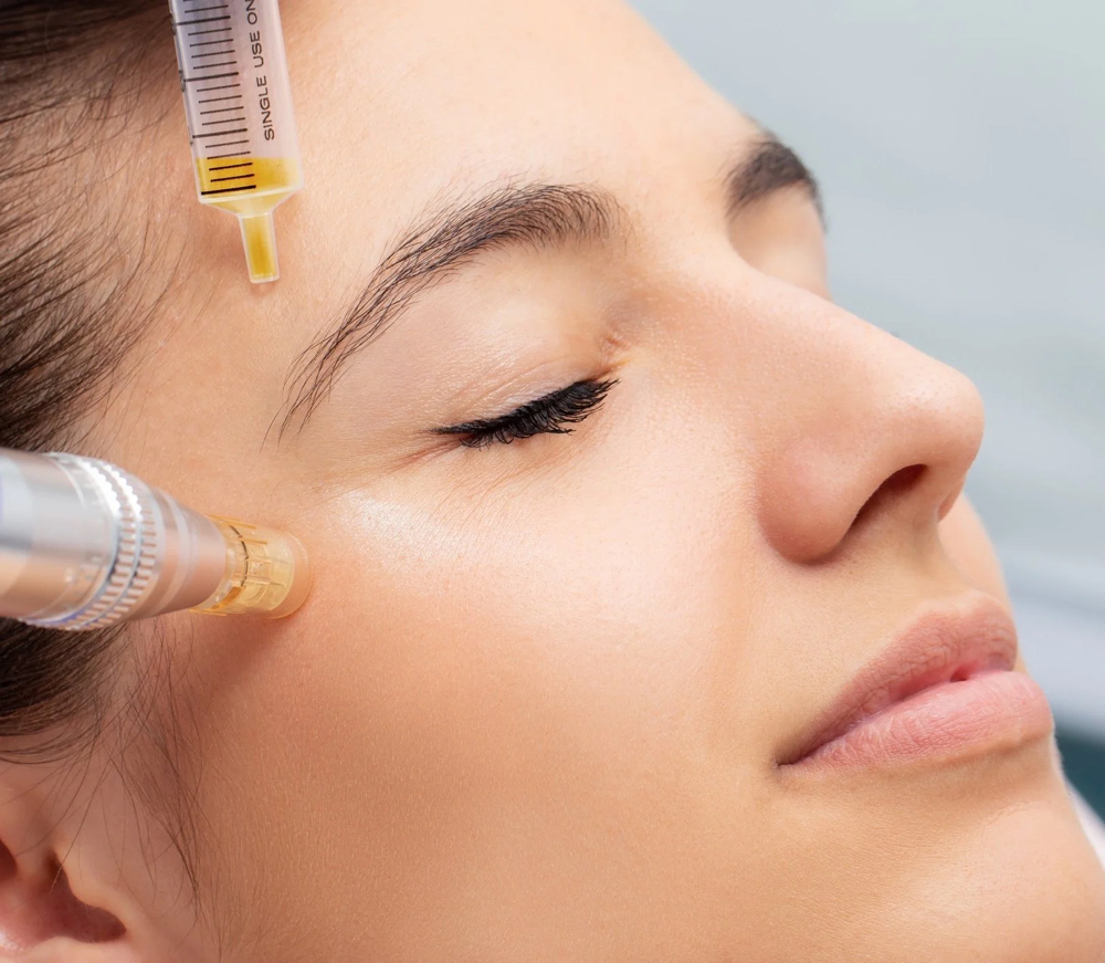 Neurotoxin-Wrinkle release at ReBourne Aesthetics and Wellness in Ridgland, MS