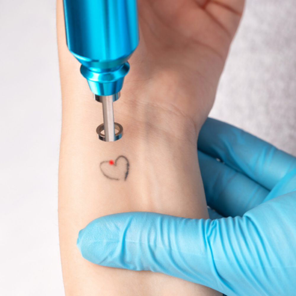 XSmall Area (1x1) TATTOO REMOVAL at BEAUTY LAB COLLECTIVE in Miami, FL
