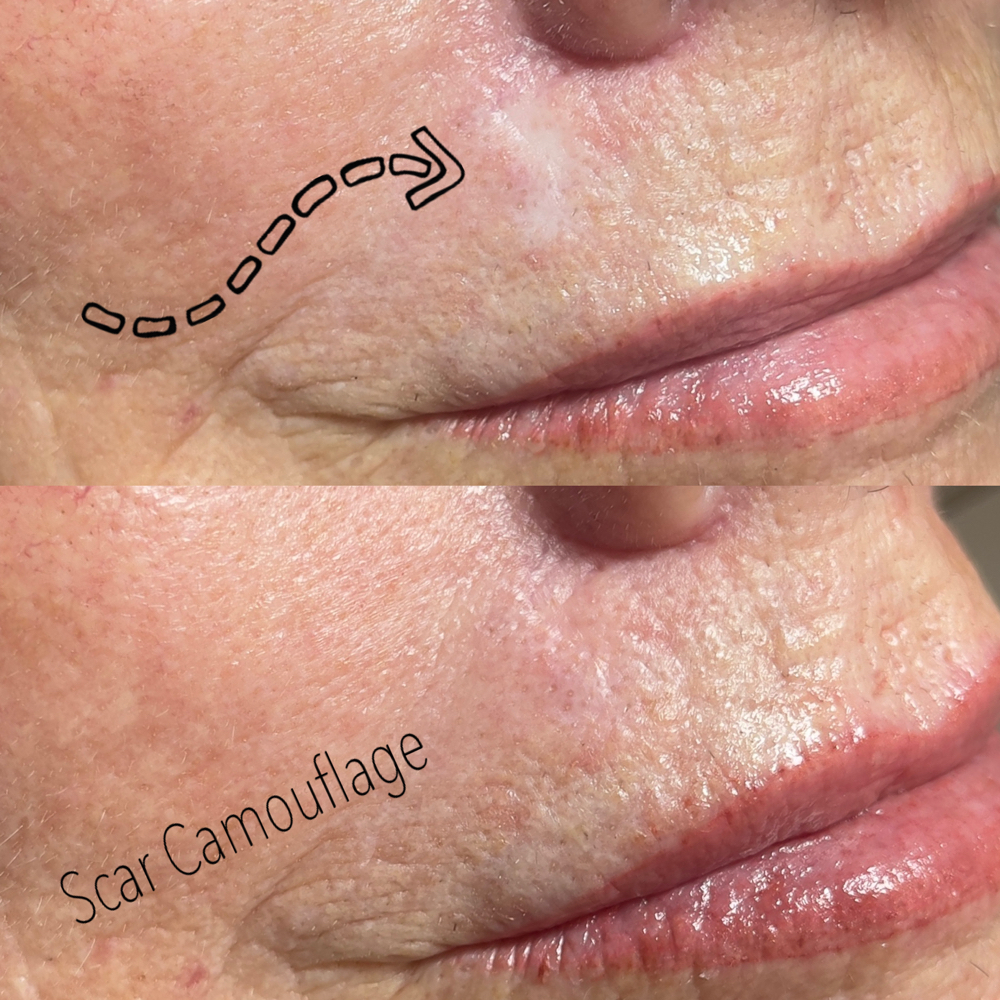 Scar Camouflage (paramedical)