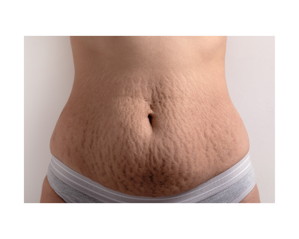 STRETCH MARKS (Bundle of 3)