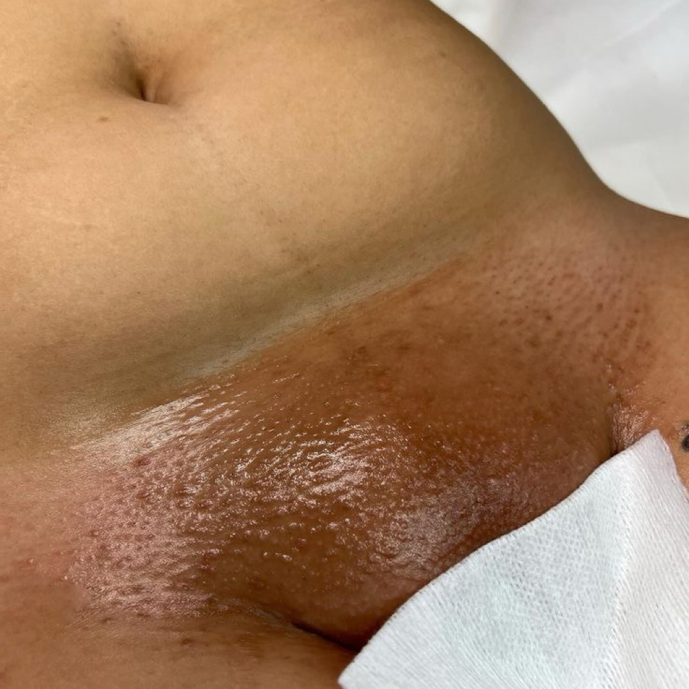 Bikini Full (Repeating Client) at GlowedByMari in Houston, TX