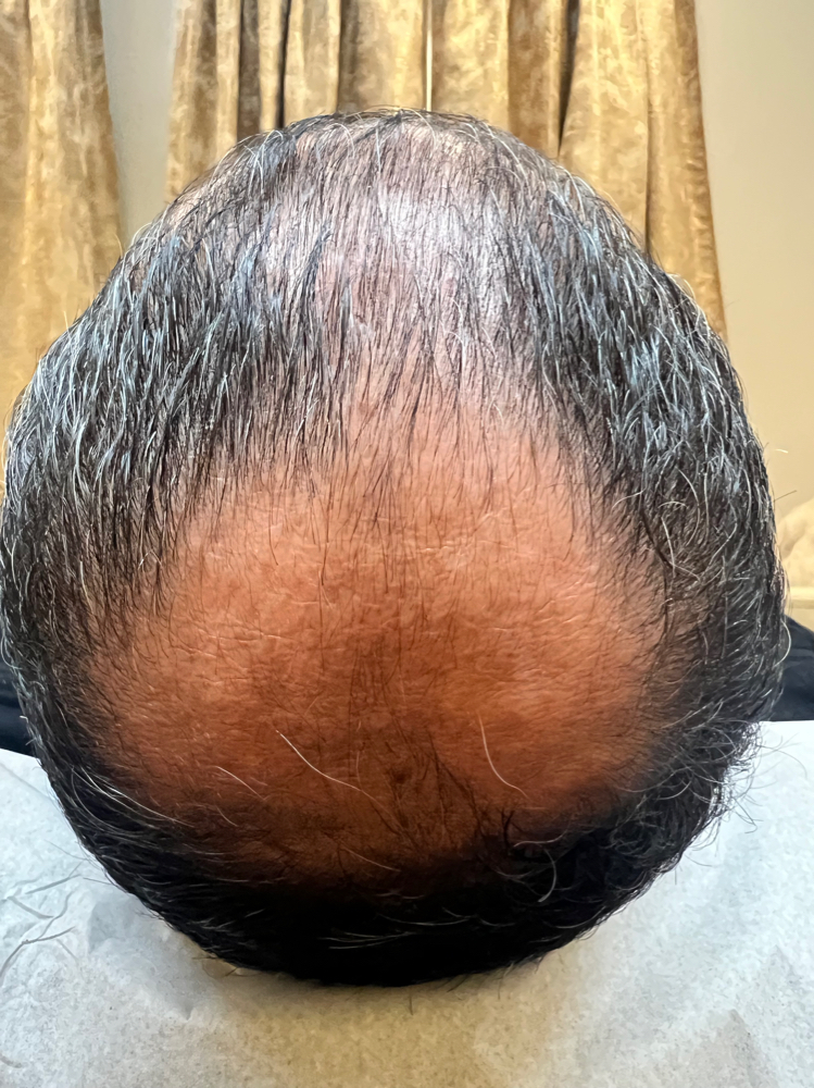 Hair Loss / Alopecia/ Scalp Txs