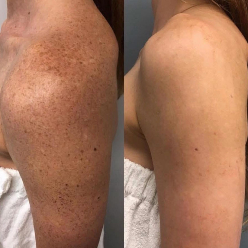 (IPL) Upper Arms at BEAUTY LAB COLLECTIVE in Miami, FL