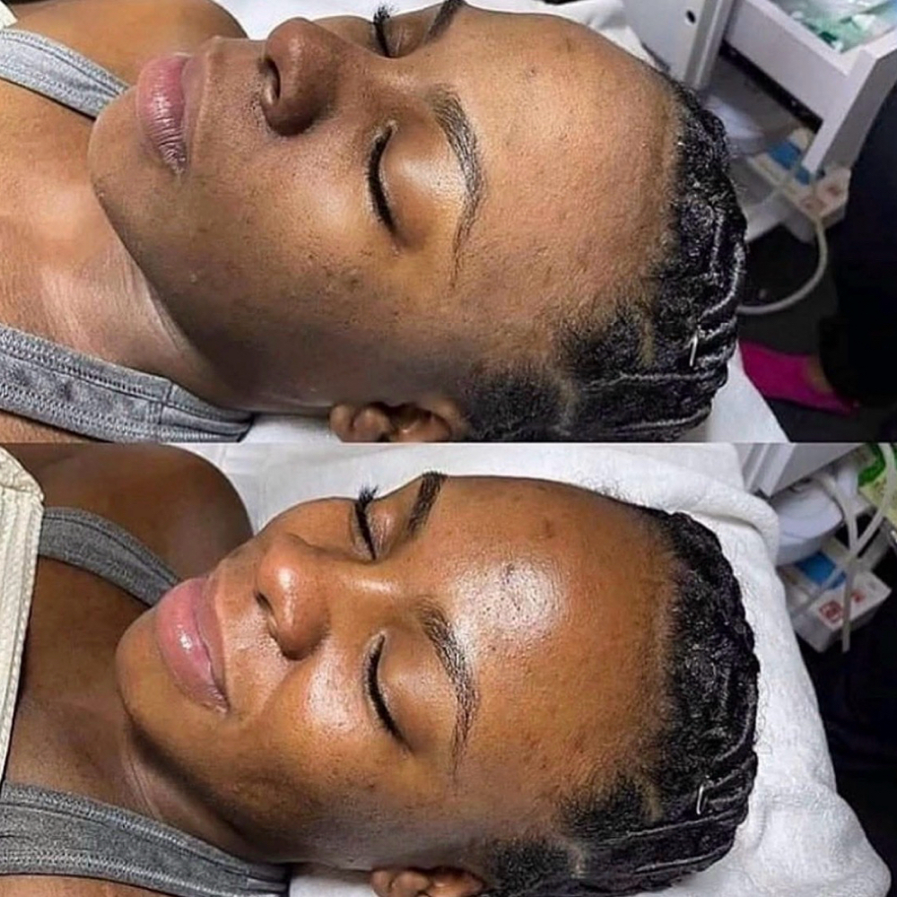 Signature Dermaplane Facial at Beauty Room Destin in Destin, FL