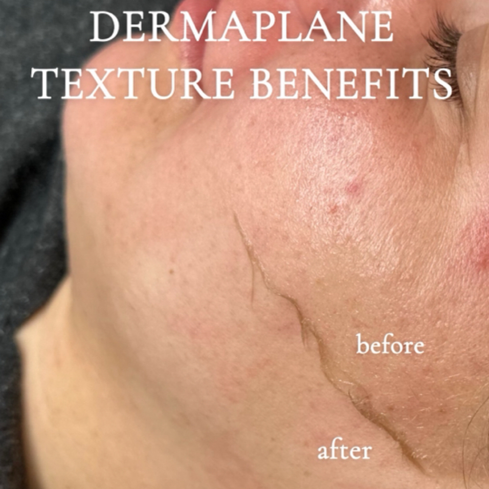 Quick Dermaplane Special ✨ at Kelsey Loiselle Aesthetics in Louisville, OH