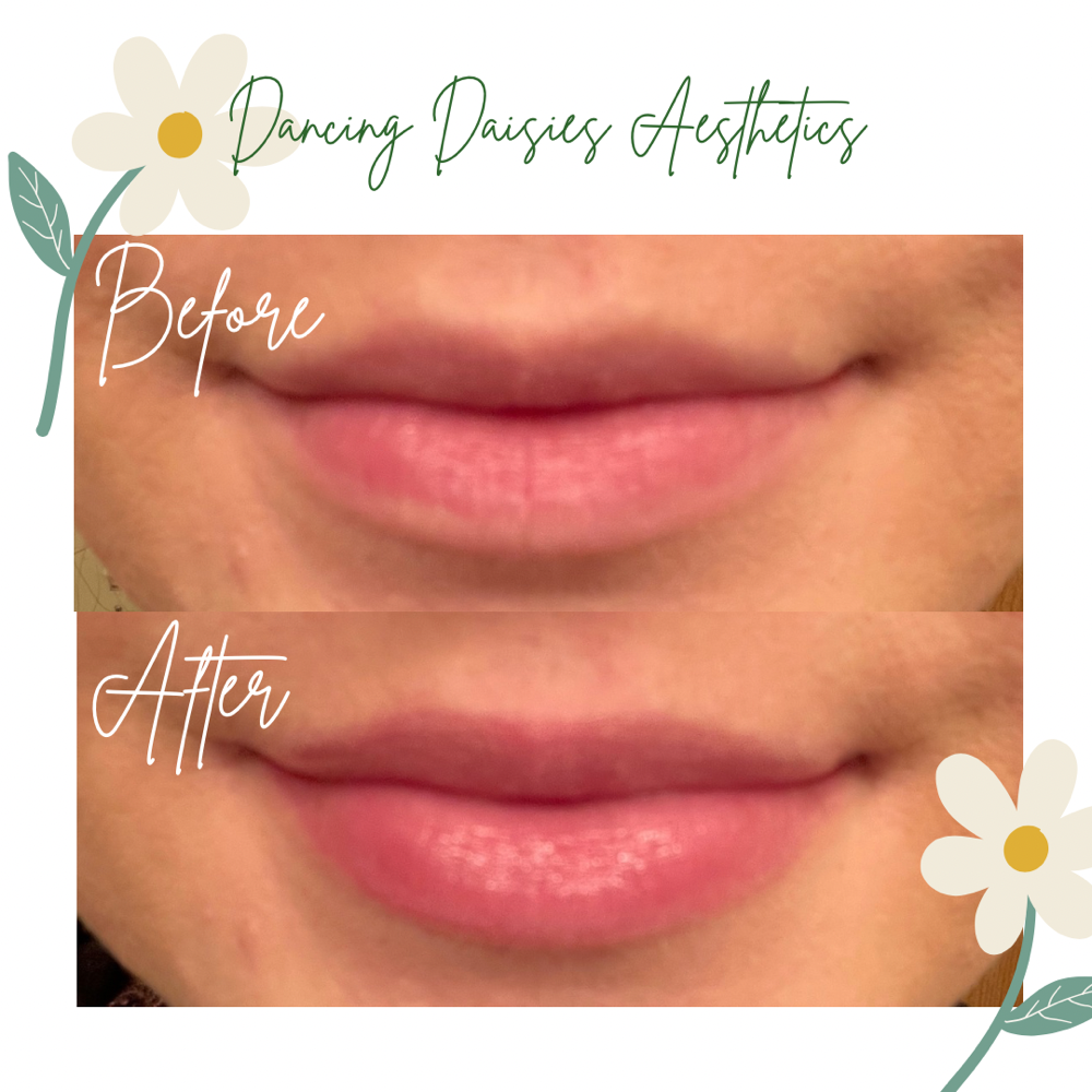Lip Bloom Add-On