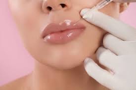 Lip Filler