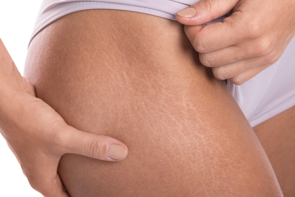 Stretch Mark Camouflage