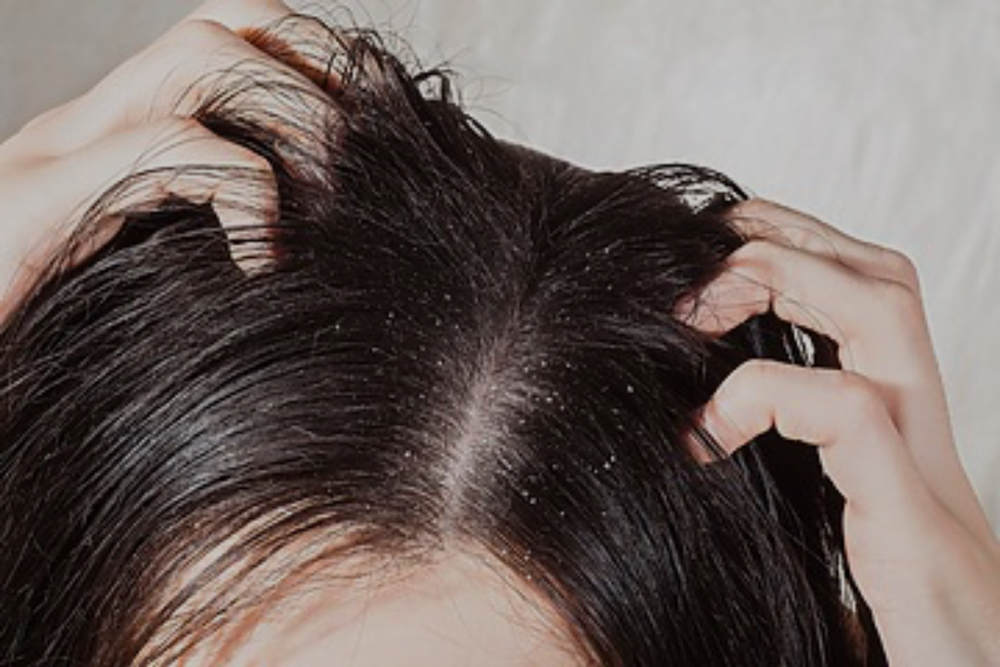 SOS Scalp Soother Therapy Plan