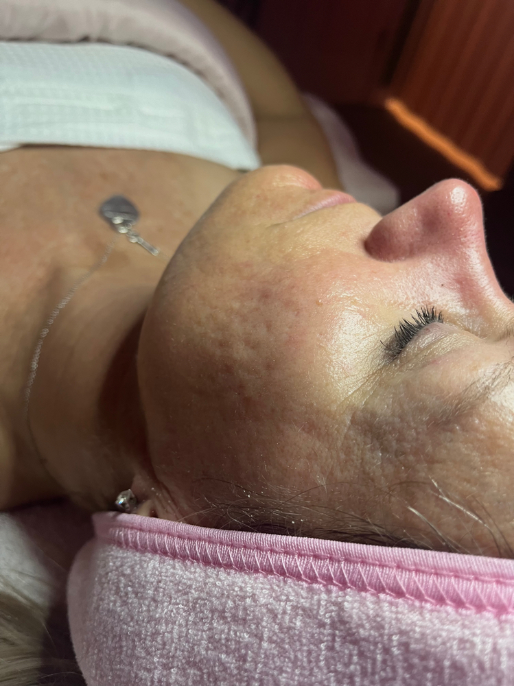 Dermaplane Facial