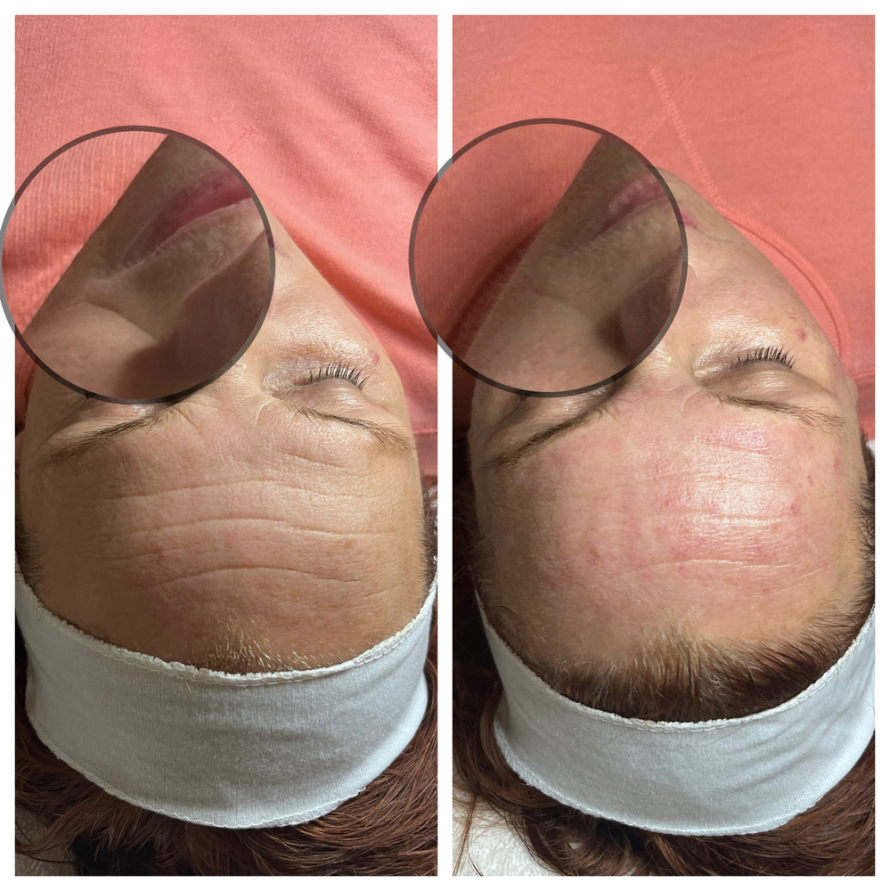 Radio Frequency (Facial add On)