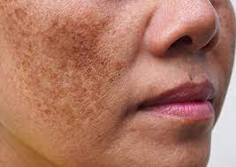 Melasma & Pigmentation Consultation