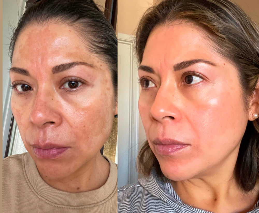 Melasma, Pigmentation Consultation