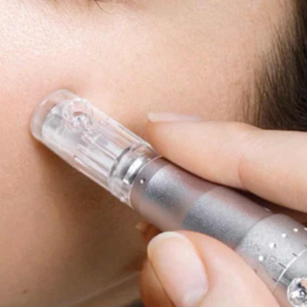 Microneedling Face Only at Uplift Aesthetics in Union City, TN