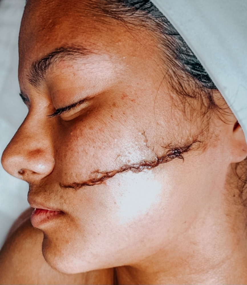 Dermaplanning
