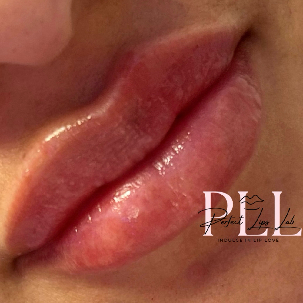 1 ML Juvederm / Restylane