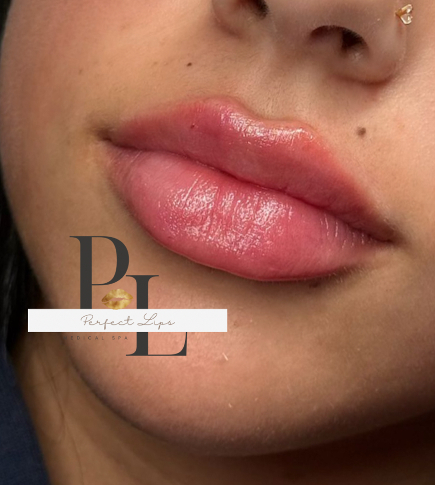 1 ML Juvederm / Restylane