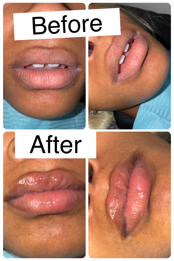 Hylaron Lip Fillers 1.5ml