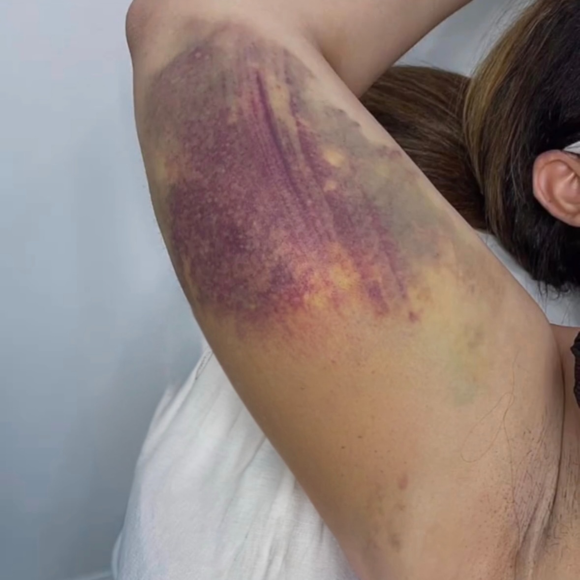 8 Arm Post Op Massage