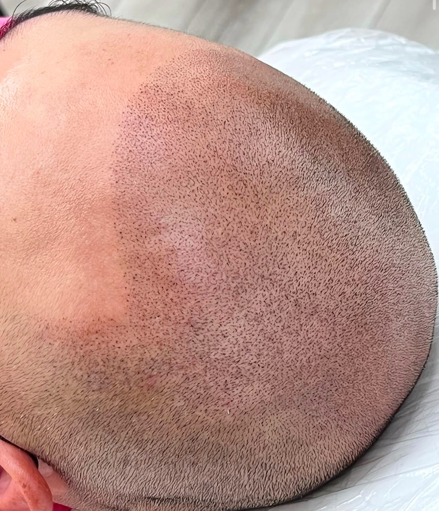 Scalp Micropigmentation (SMP) 1hr+