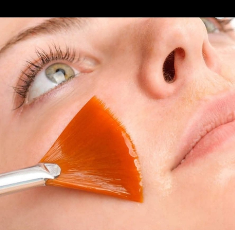 Chemical Peel