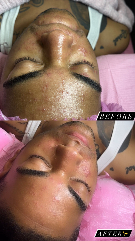 Gentlemen Acne Facial ✨🤎