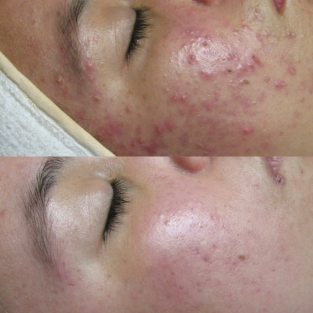 Acne Bootcamp Consult + Treatment