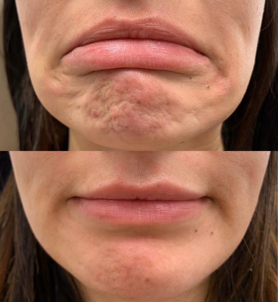 Tox- Daxxify Mentalis (Chin)