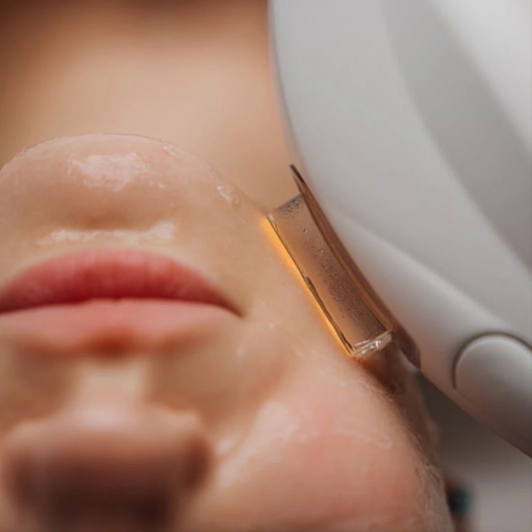Pigment & Sun damage Removal at CIAO AESTHETICS in Youngstown, OH
