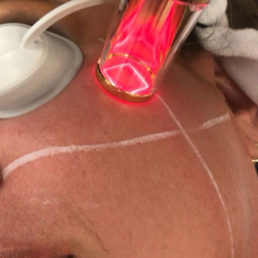Rinovare Fraxel Laser Full Face at Remake Beauty Studio Mcallen in McAllen, TX