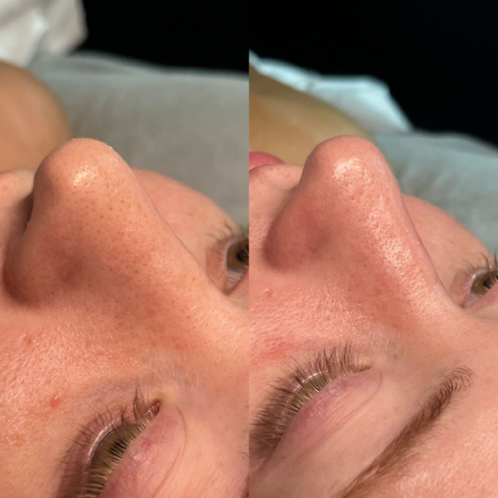 HydroDiamond Facial at Envy Esthetics HR in College Station, TX