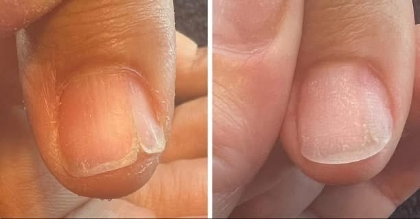 Nail Repair