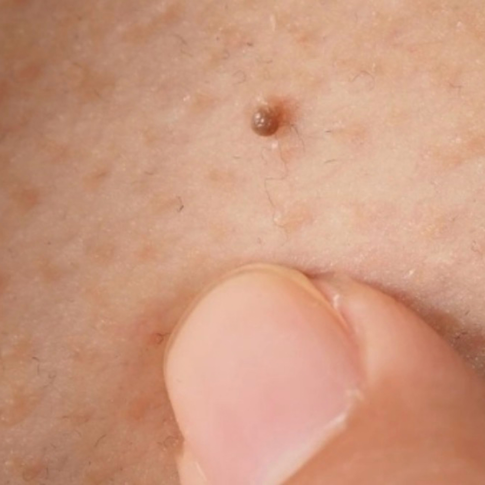 Skin Tags at Remake Beauty Studio Mcallen in McAllen, TX