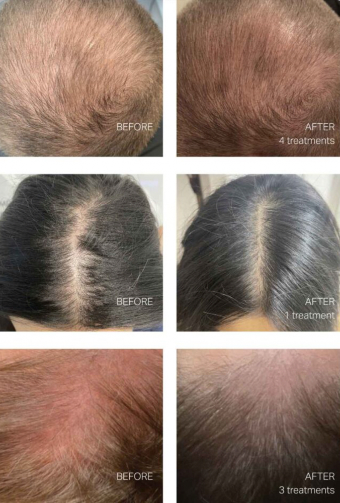 Keravive Hair restoration