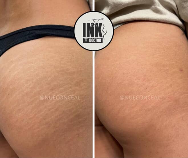 FREE stretchmark Consultation