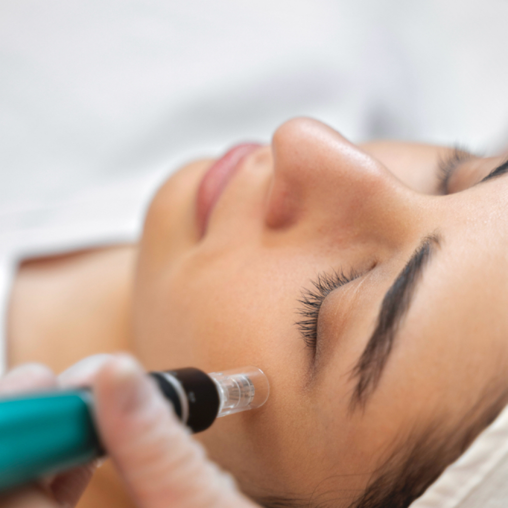 Skin Renewal Microneedling at Glow by Inna in Costa Mesa, CA