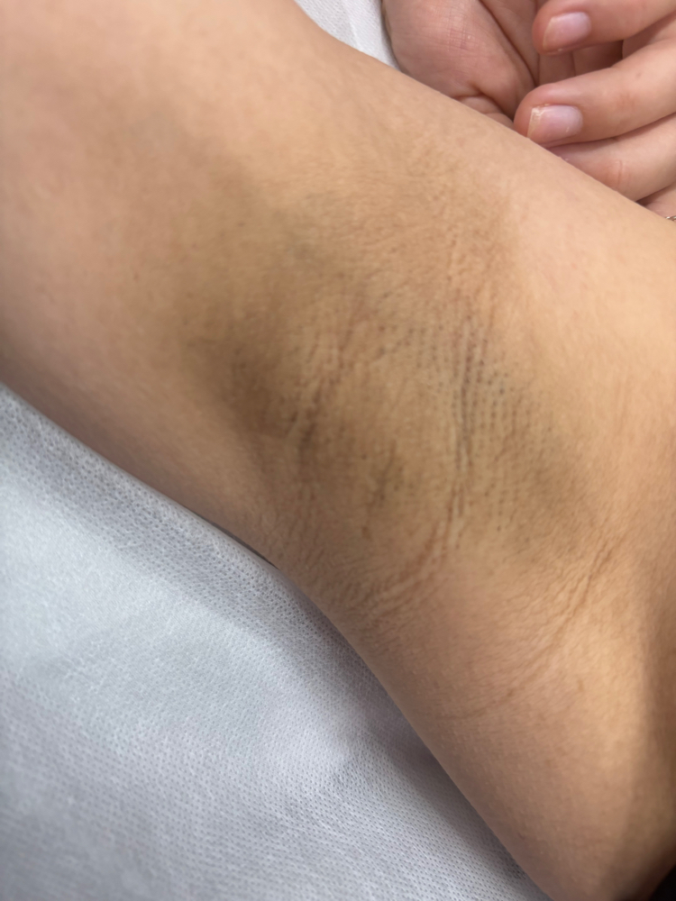 Underarm Laser Treatment at Aestheticbylola in Bronx, NY