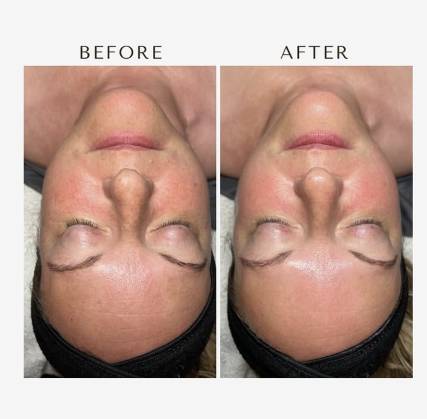 Basic Facial