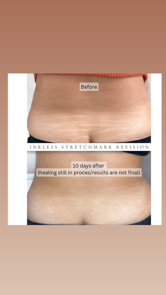 Stretch Mark Rivision