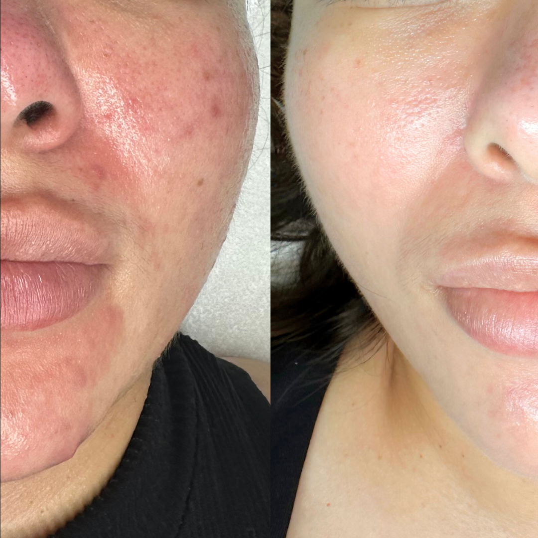 Single Acne Treatment