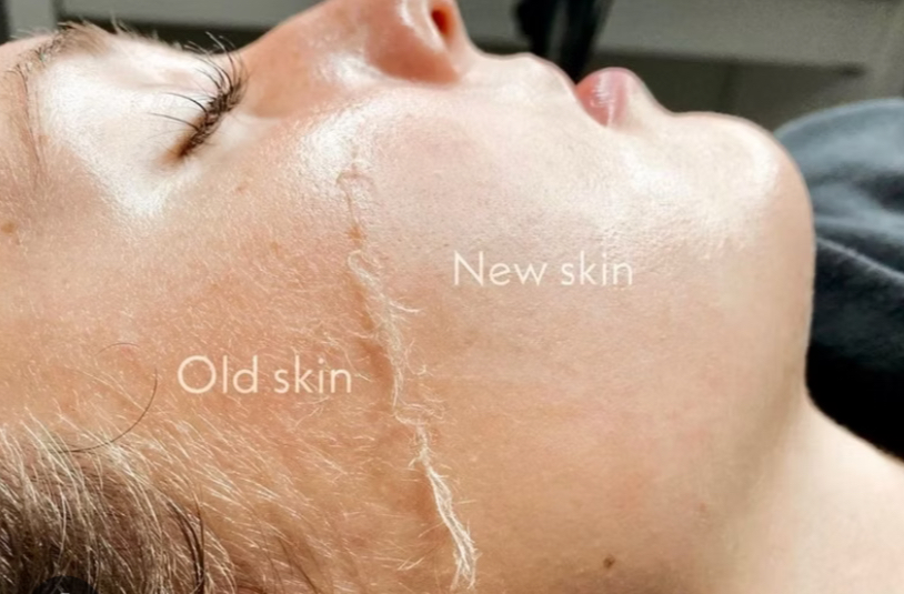 Dermaplane
