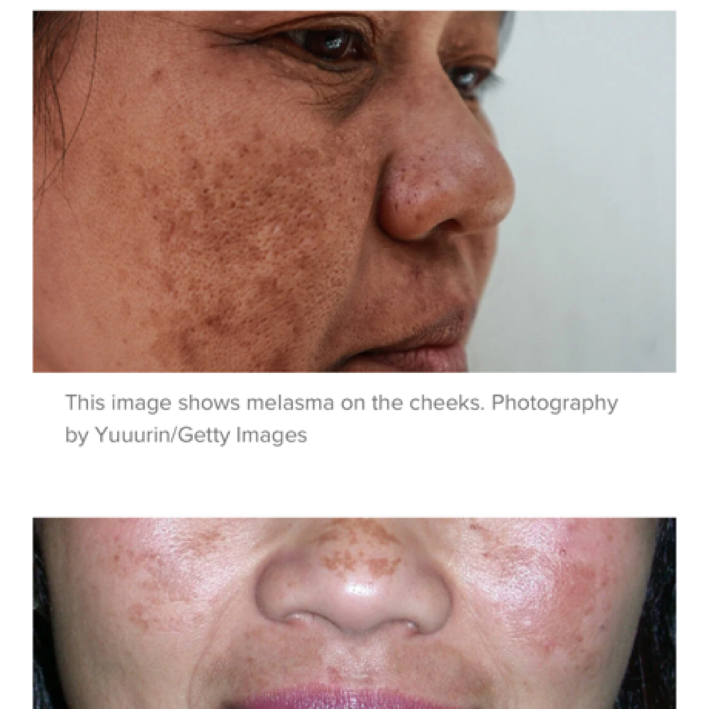 Deep Exfoliation For Pigment Change at Okchamali Spa in San Antonio, TX